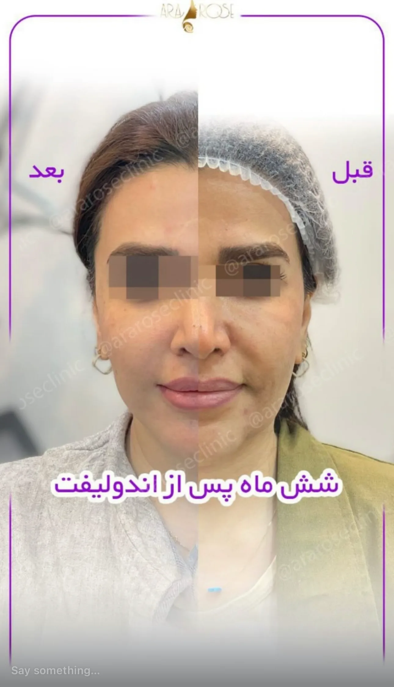 نتایج اندولیفت