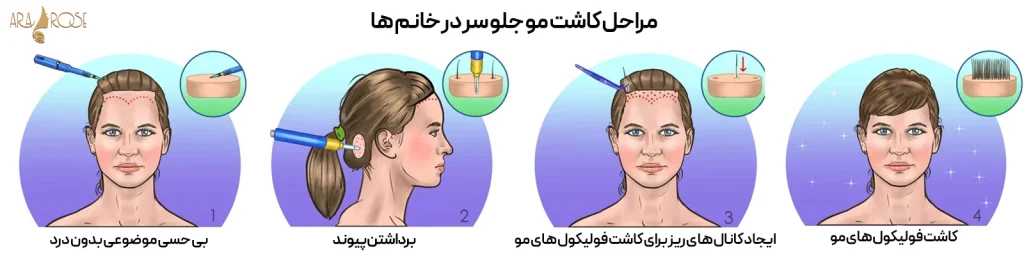 مراحل کاشت مو جلوی سر در بانوان
