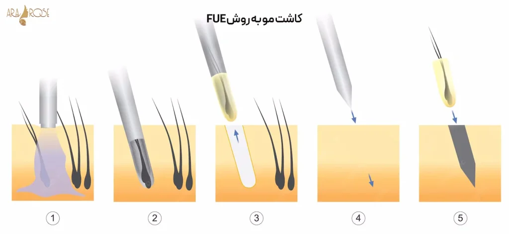 کاشت مو به روش fue