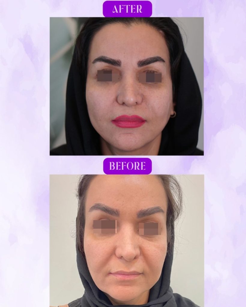 قبل و بعد اندولیفت در کلینیک آرارز