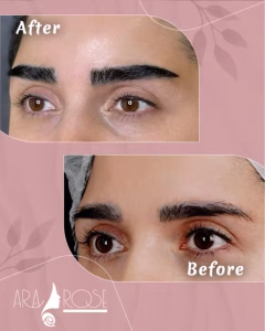 کاشت ابرو در مشهد، کاشت ابرو دکتر دلقندی