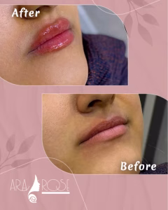 تزریق ژل لب دکتر دلقندی